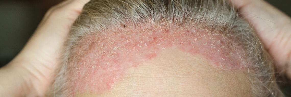 Psoriasis vulgaris (Plaque-Psoriasis) tritt oft auf der Kopfhaut auf.